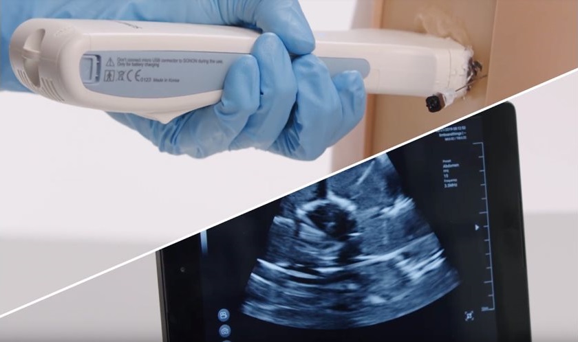 61002_ultrasound-guided-epidural-and-lumbar-puncture-02.png