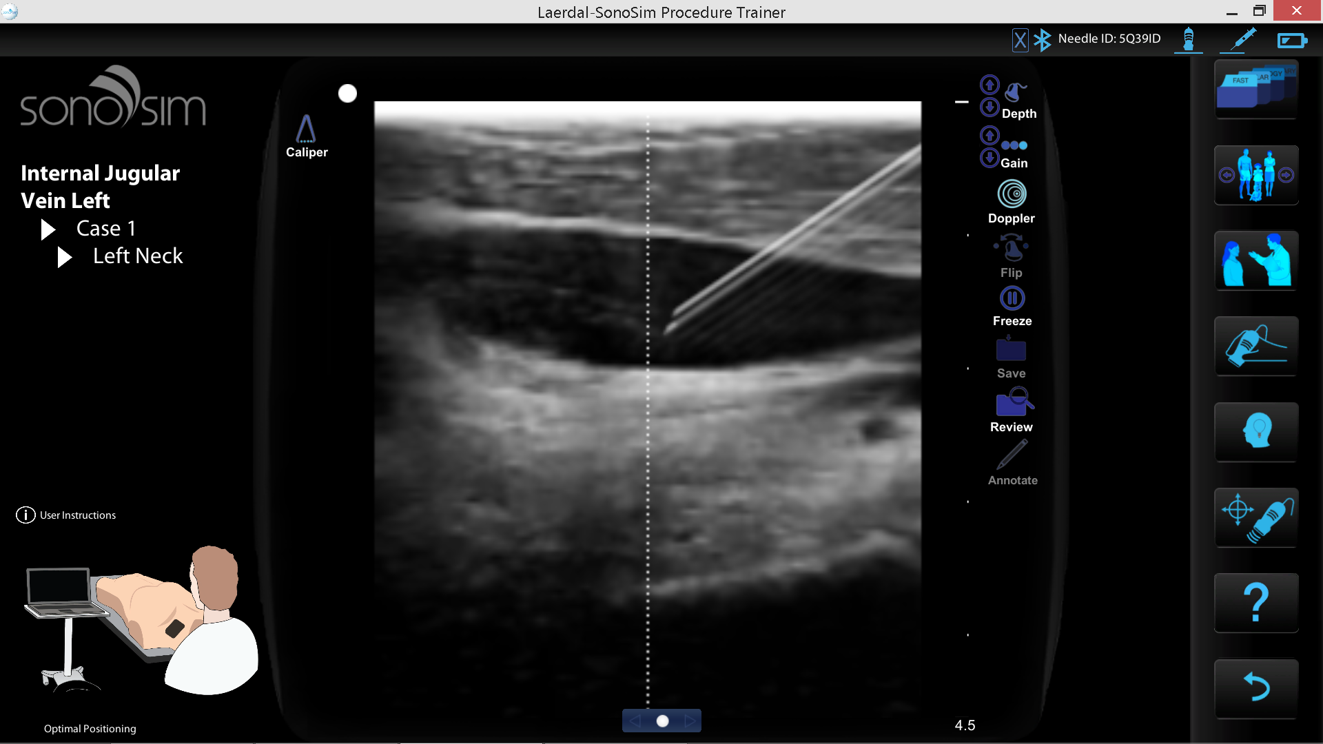 Needle in Vein Internal Jugular Vein Left