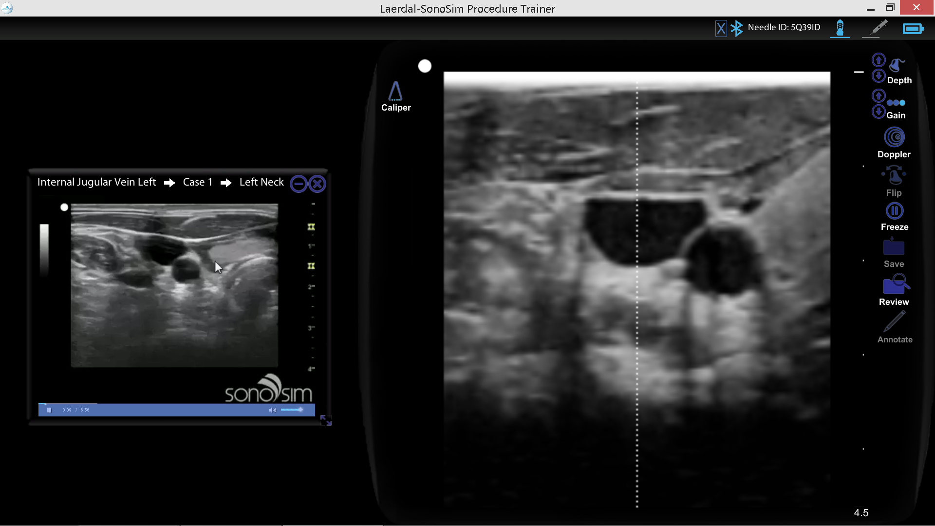 Internal Jugular Vein Left