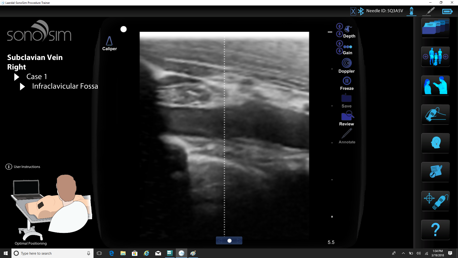 Right Subclavian Long.png